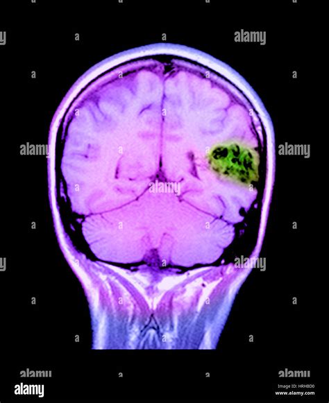 Image result for AVM Brain