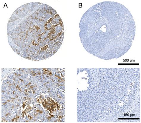 TREM2 Is Associated with Advanced Stages and Inferior Prognosis in Oral ...