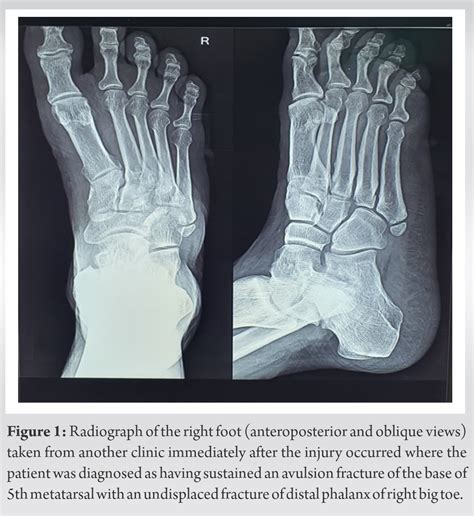Red Herring in Orthopedics: A Case Report on Painful Os Vesalianum Pedis Masquerading as an ...