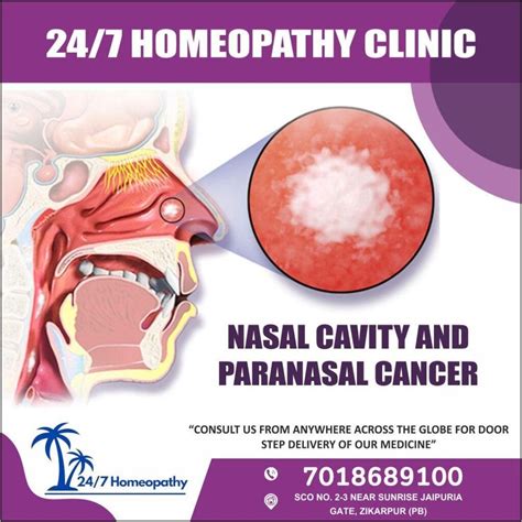 NASAL CAVITY AND PARANASAL CANCER - 247homeopathy