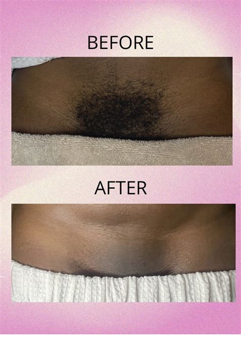 Brazilian Wax Results