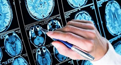 Image result for Dat Scan Lewy Body