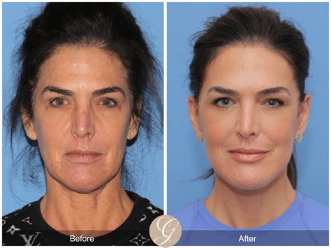 Face Lift Before And After Near Me - EMSEKFLOL.COM