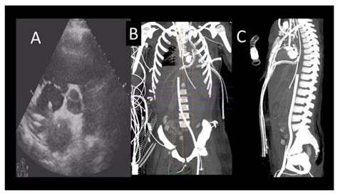 Multimodality Imaging in Advanced Heart Failure for Diagnosis ...