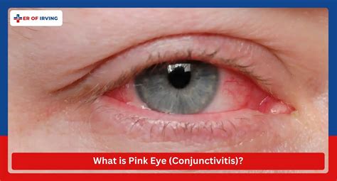 How Do I Know If I Have Pink Eye? How to know whether it's contagious or not?