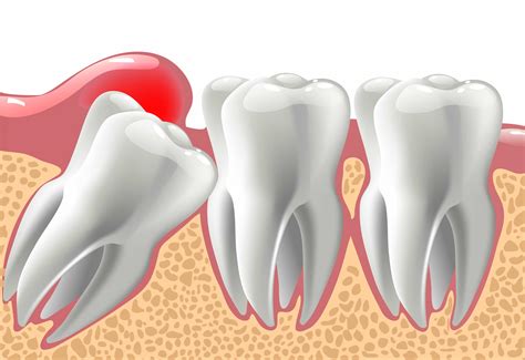 Wisdom Teeth Removal Healing Process Pictures