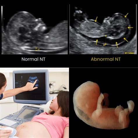Nuchal Translucency (NT) Scan: Early Screening for Baby’s Health