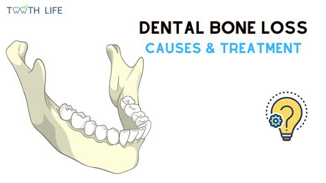 Why Bone Loss Happens in Teeth And How You Can Fix It