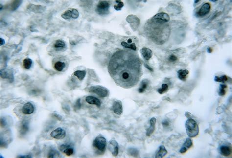 Rising concerns over brain-eating amoeba infections