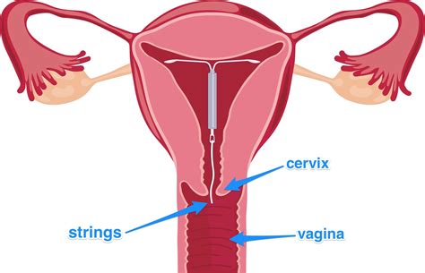 How to check IUD strings - Business Insider