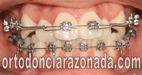 Pasos para verificar la alineación de las piezas del arco