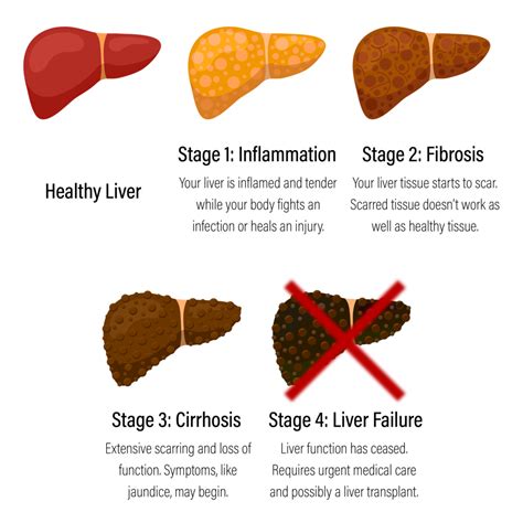 Liver Fibrosis Symptoms