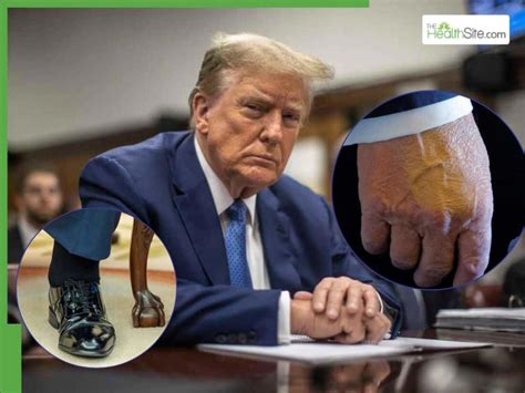 Donald Trump Health Update: Chronic Venous Insufficiency To Hand ...