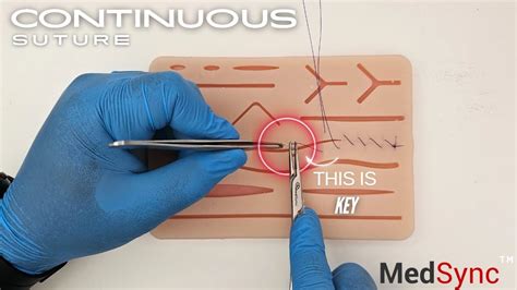 Image result for Simple Continuous Suture Removal