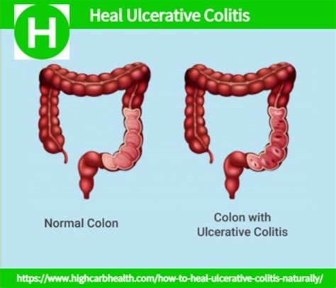 ulcerative colitis vs diverticulitis