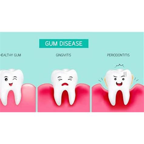 What Does Gingivitis Look Like: Recognizing the Signs of Gum Disease - Smile Studio Boston