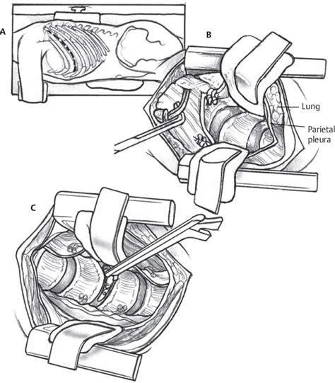 Image result for Thoracotomy Recovery