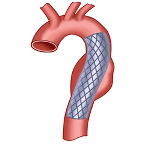 How long venous graft lasts? | Dr. O P Yadava