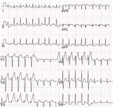 Image result for AFib Detection Algorithm