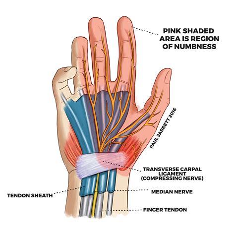 Mr Paul Jarrett | Carpal Tunnel Syndrome | Murdoch Orthopaedic Clinic