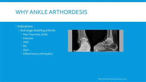Ankle Arthrodesis, Approach and Surgical Techniques.pptx