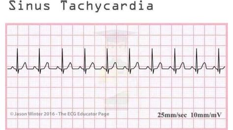Basic ECG Rhythms 的图像结果