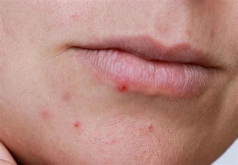 Image result for Pimple From Dry Lips