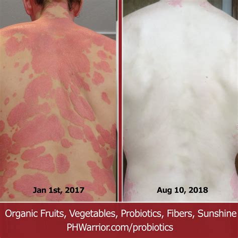 Psoriasis Pictures and Video September 1st 2018 - A Warrior Curing Psoriasis Naturally
