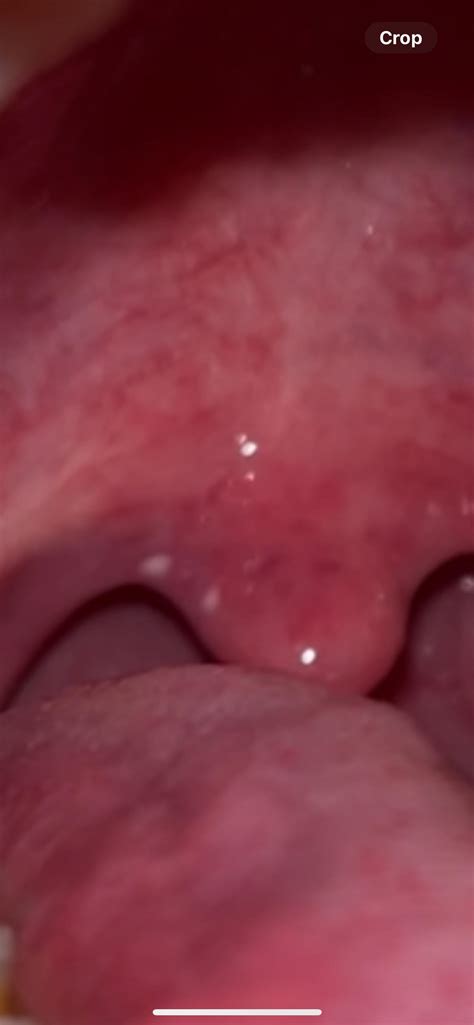 White spot on uvula : r/medical_advice