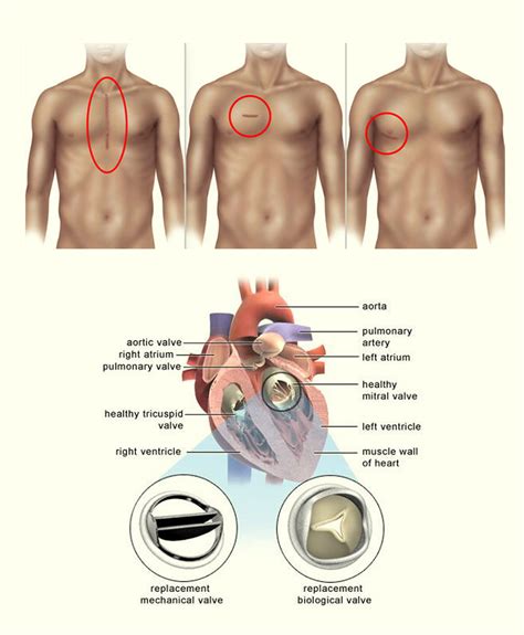 Mitral Replacement Valve