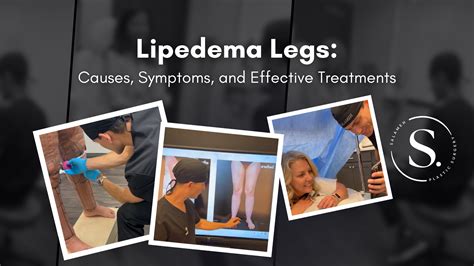 Understanding Lipedema Legs: Causes, Symptoms, and Treatment - Salameh Plastic Surgery Center