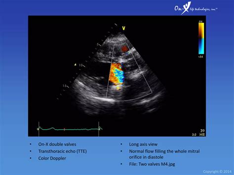 On-X Heart Valve Echocardiography | PPTX