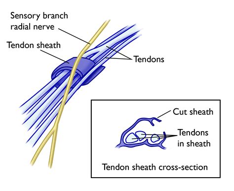 De Quervain's Tenosynovitis - OrthoInfo - AAOS