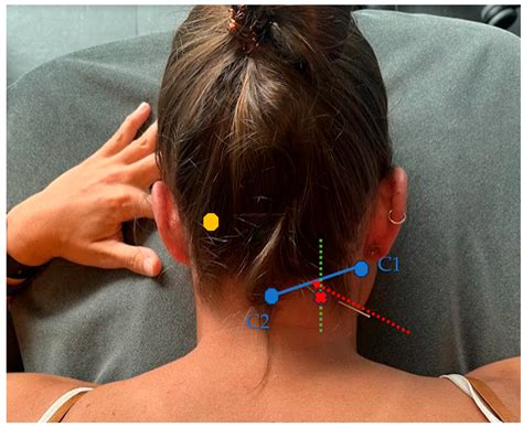 Effects of Dry Needling of the Obliquus Capitis Inferior in Patients ...