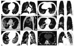 新型冠状病毒肺炎32例临床表现及影像学特征初探