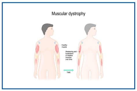 Muscular Dystrophy: Symptoms, Diagnosis, and Treatment
