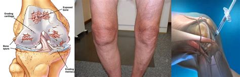knee pain treatment Archives - Singapore Orthopaedic Centre