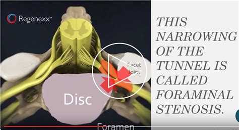 What Is Foraminal Narrowing Of The Cervical Spine at Nathan Frank blog