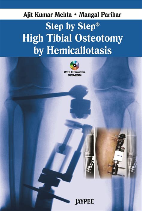 Buy Step by Step High Tibial Osteotomy by Hemicallotasis Book Online at ...