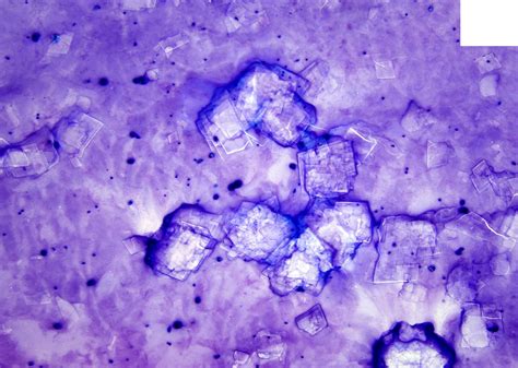 Thyroglossal Duct Cyst Cytology
