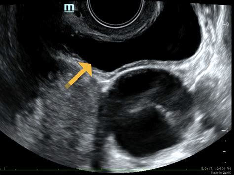 Womens Health Normal Ovary Ultrasound
