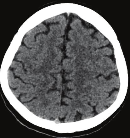 Image result for Normal Brain CT Scan