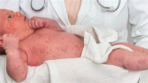 Why Is There A Growing Misinformation On Measles?