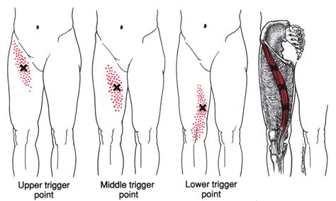Femoral Triangle Trigger Points
