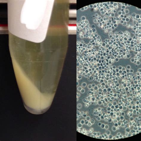 Urine Sediment of the Month: The Visible Sediment - Renal Fellow Network