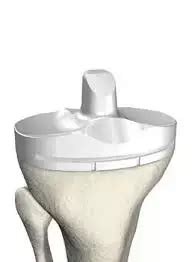 Use of all-polyethylene tibial component improves outcomes in obese ...