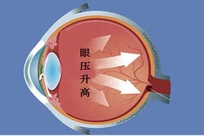 知晓青光眼：高眼压症有多少几率发展成青光眼？ - 知乎
