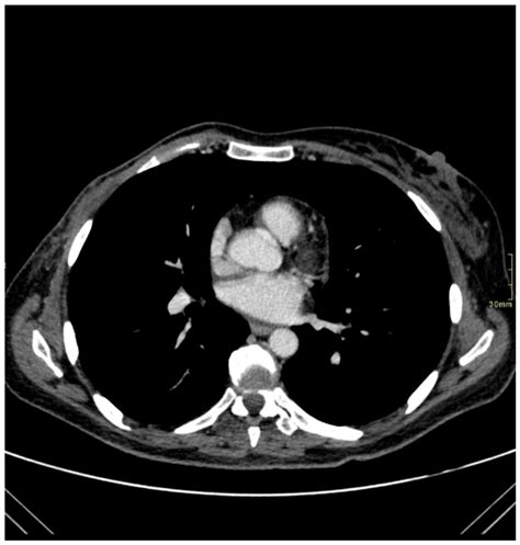 Anti-Ri Paraneoplastic Neurological Syndrome Presenting with Ocular ...