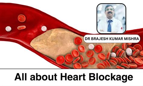 Understanding and Managing Heart Blockages: Causes, Diagnosis, and ...