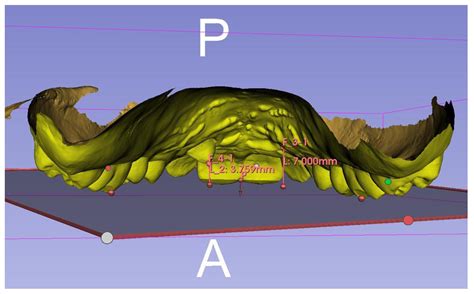 Photobiomodulation Therapy to Stimulate Autonomous Eruption of ...